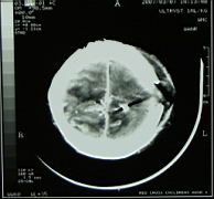 gunshot to brain in 4 yo.jpg